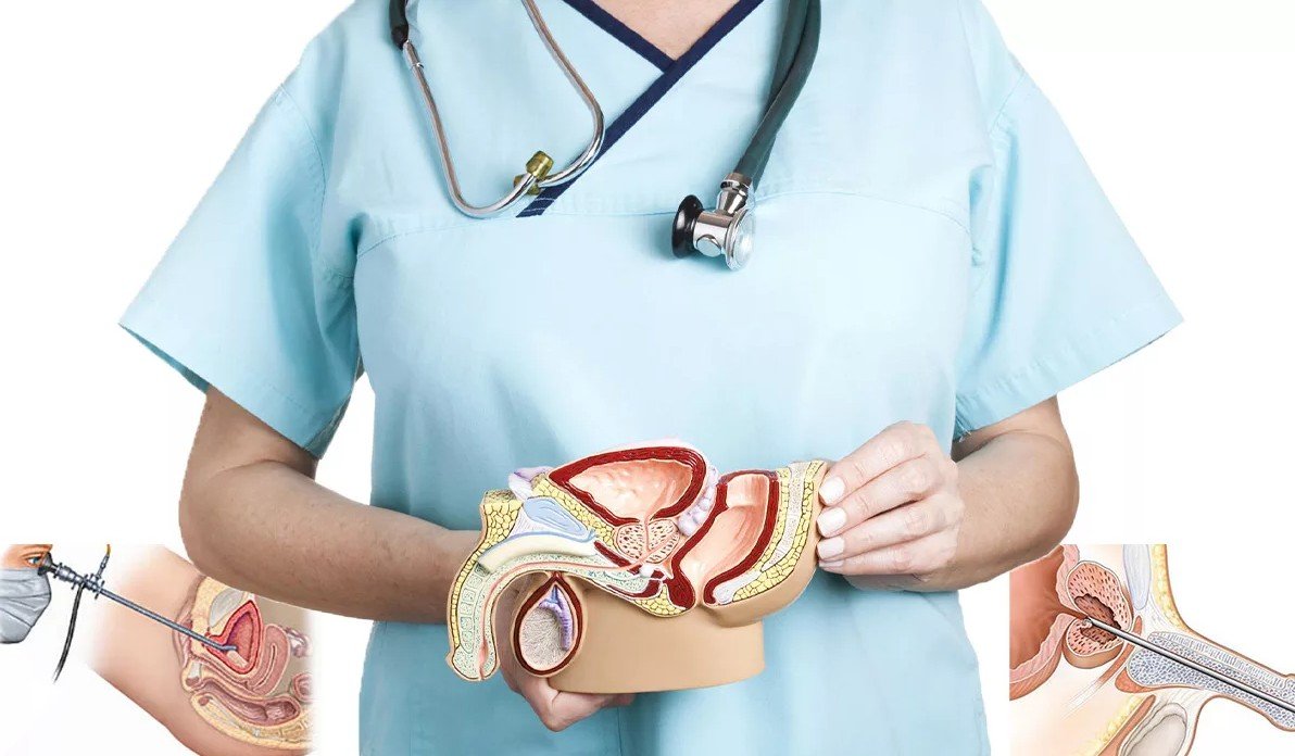 Бужування уретри