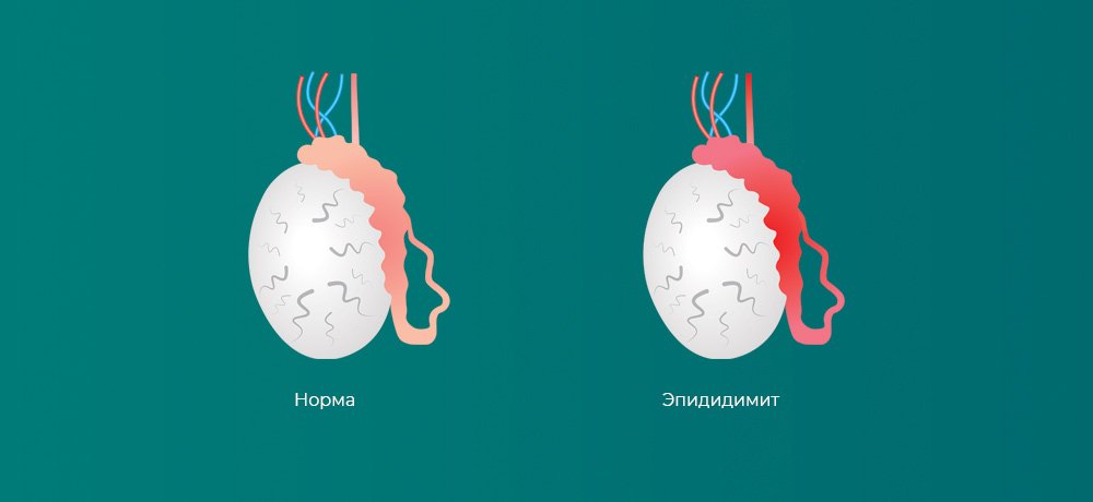 Эпидидимит