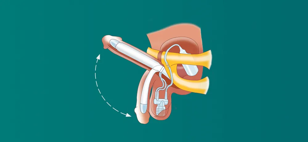 фаллопротезирование, установка протеза полового члена