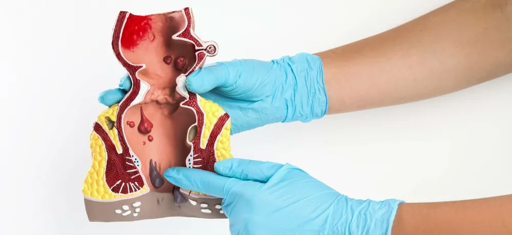 Геморроидэктомия, удаление геморроя, Гемороїдектомія, видалення геморою