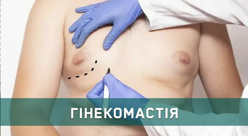 Гінекомастія у чоловіків