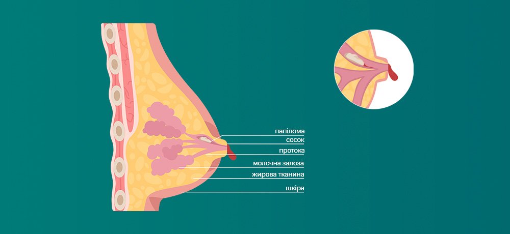 Внутрішньопротокова папілома молочної залози