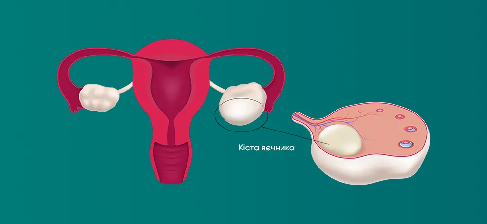 Кіста яєчника
