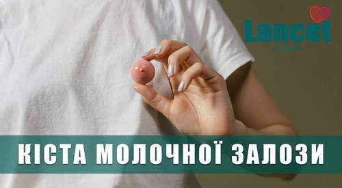 Киста молочной железы: что нужно знать каждой женщине
