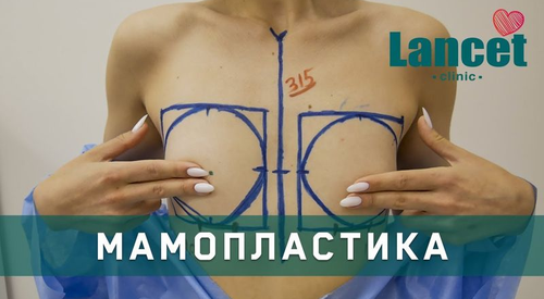 Клінічний кейс: мамопластика