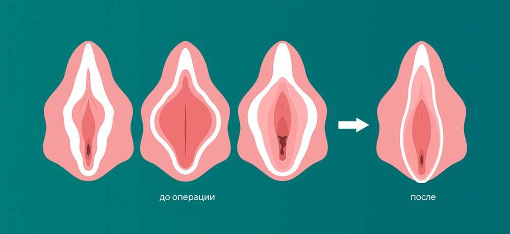 Лабиопластика, Пластика половых губ