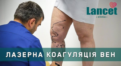 Ендовінозна лазерна коагуляція вен