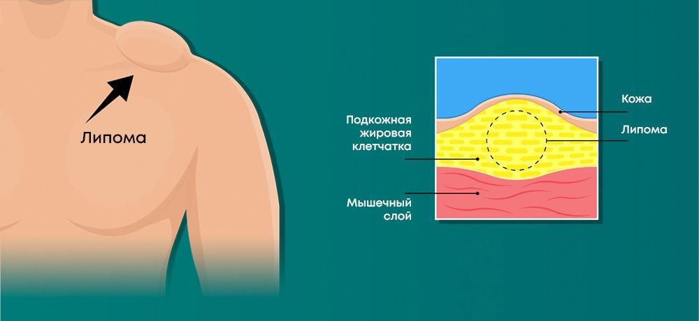 липома, жировик