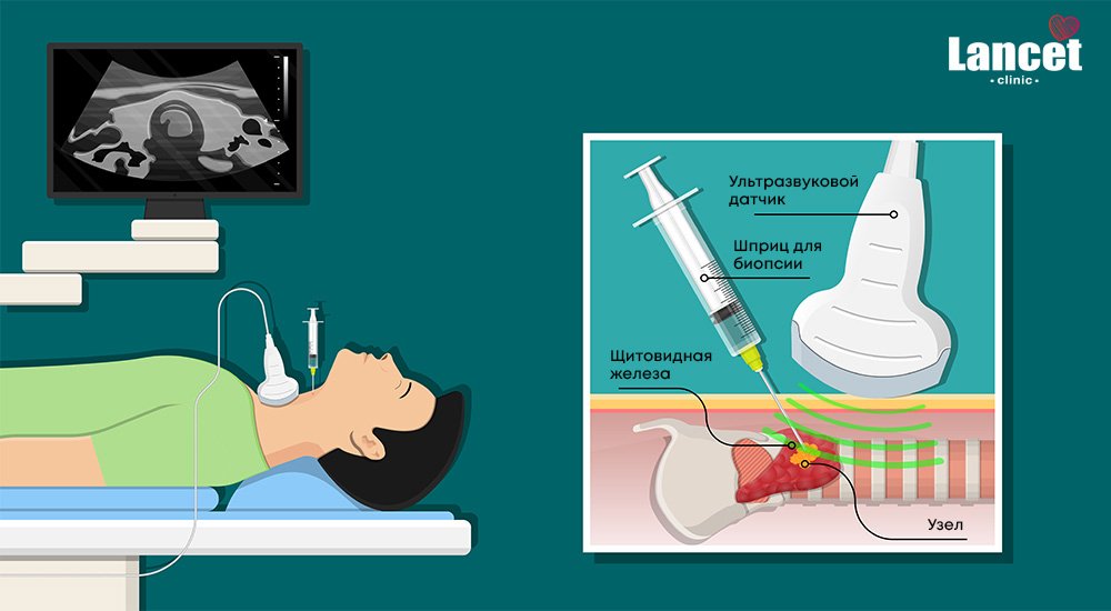 Тонкоигольная аспирационная биопсия щитовидной железы