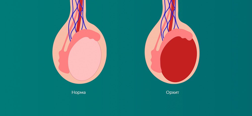 Орхит, воспаление яичка