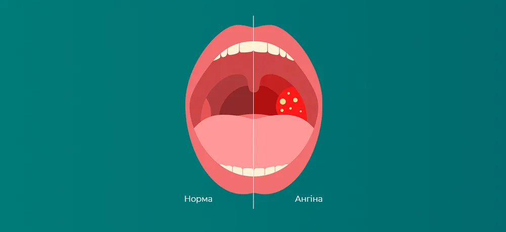 Гострий тонзиліт (ангіна)