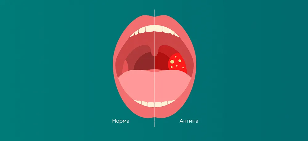 Острый тонзиллит (ангина)