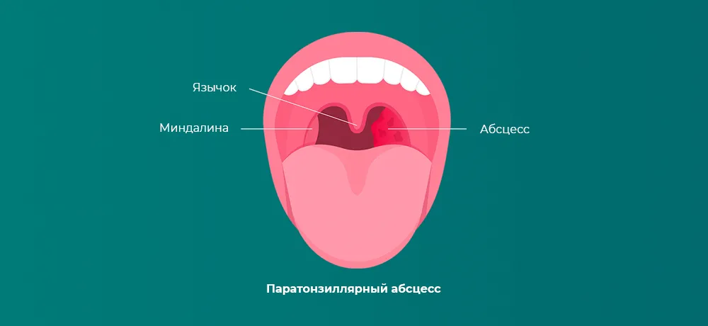 Паратонзиллярный абсцесс