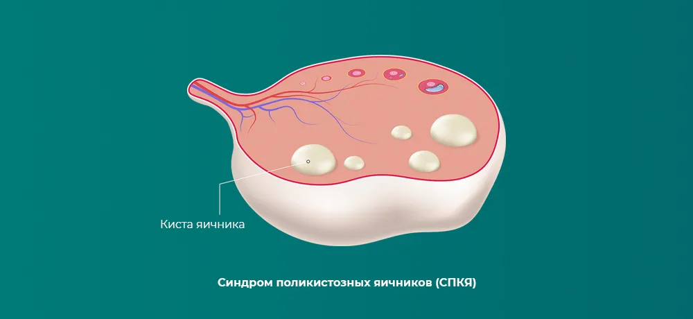Синдром поликистозных яичников (СПКЯ)