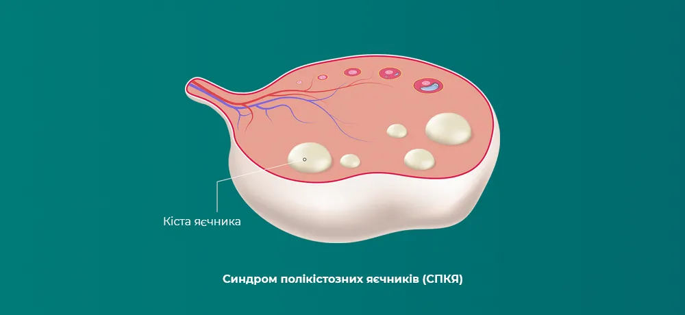 Що таке полікістоз яєчників (СПКЯ)
