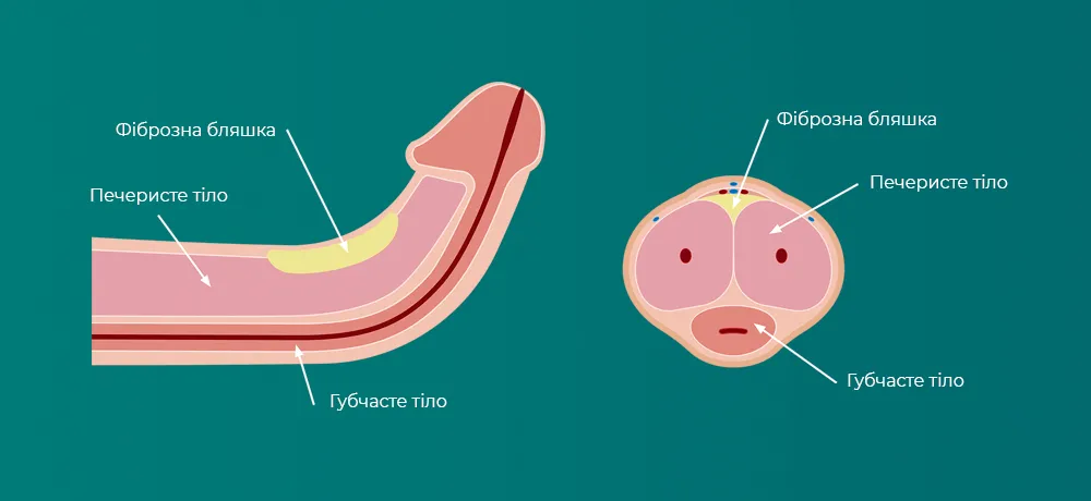 Хвороба Пейроні, фіброз статевого члена, викривлення статевого члена