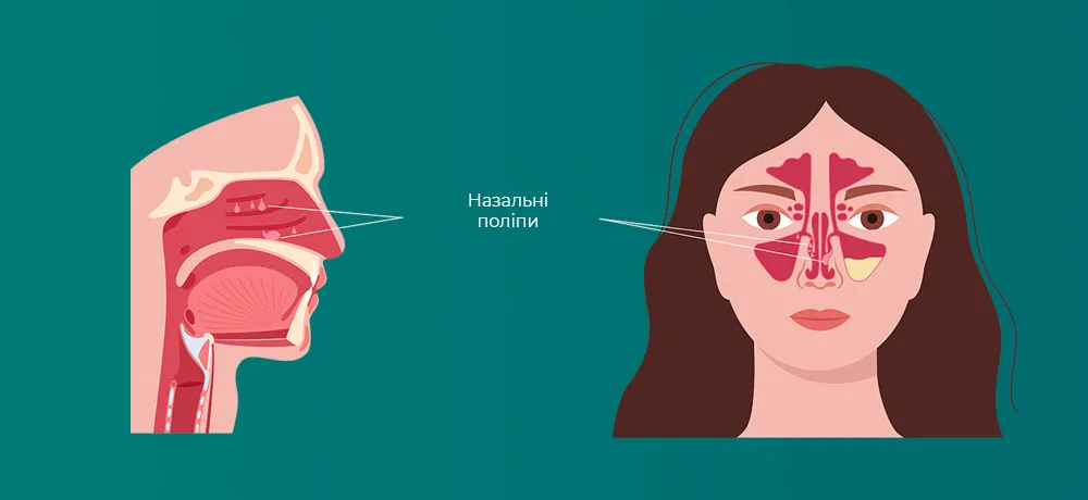 Поліпи в носі, Поліпозний риносинусит, Назальні поліпи
