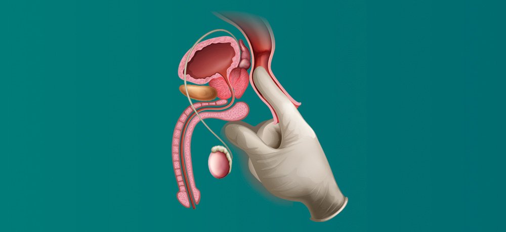 массаж предстательной железы, массаж простаты, масаж передміхурової залози, масаж простати