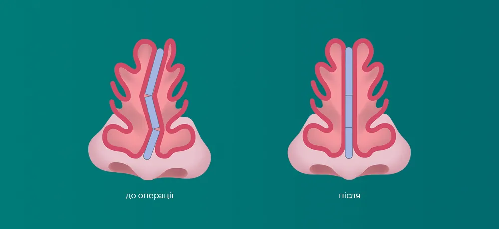 септопластика носа, випрямлення носової перегородки