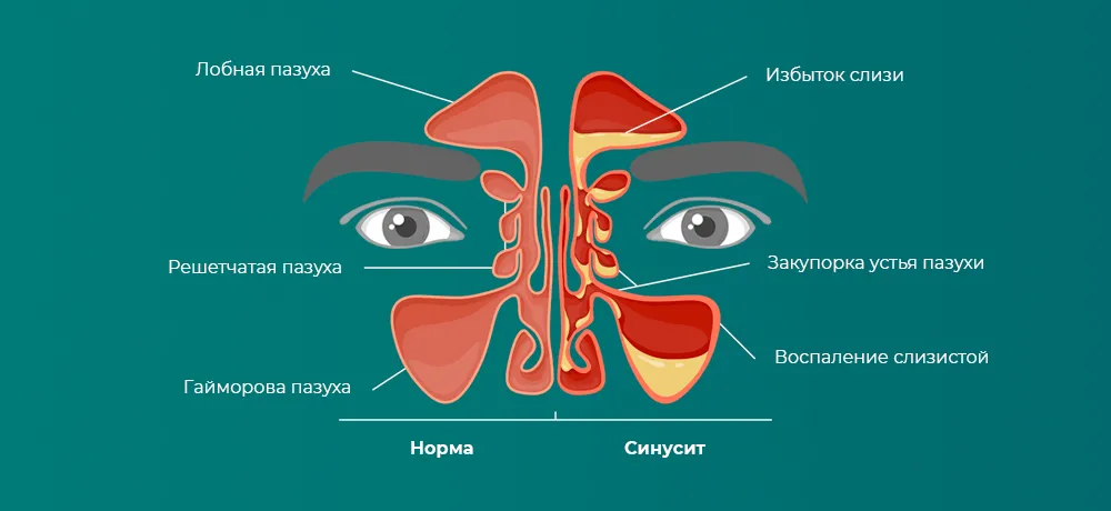 Синусит, острый и хронический синусит