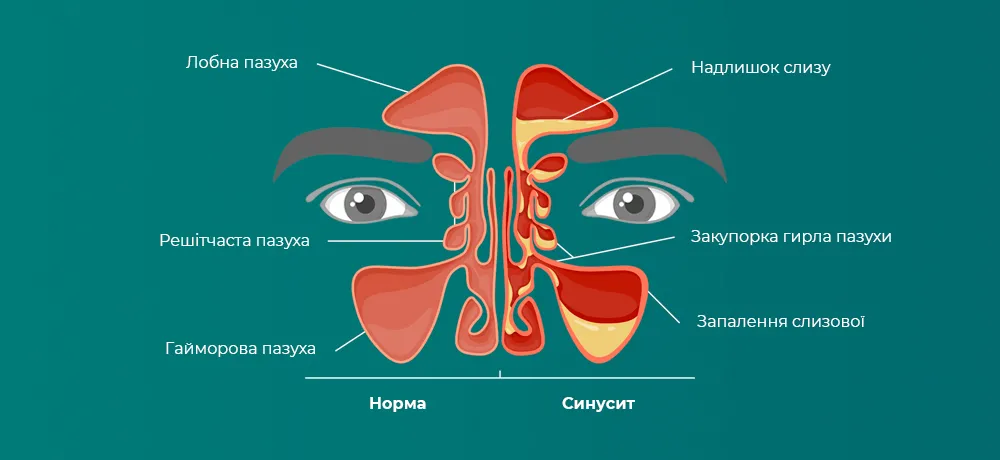Синусит, гострий і хронічний синусит