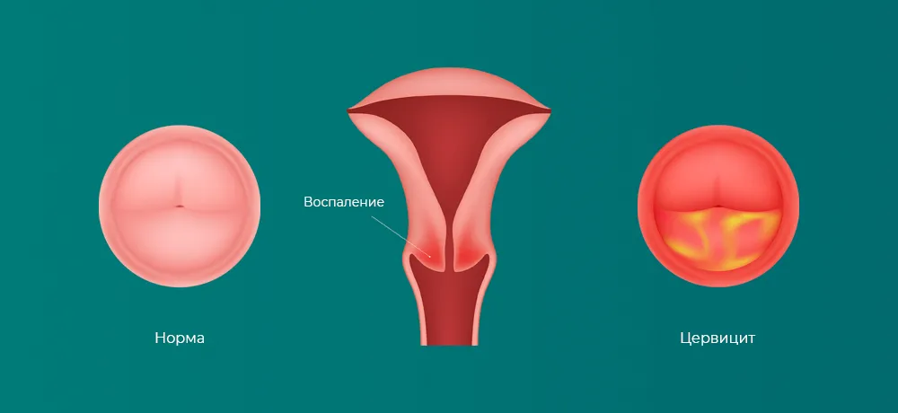 Цервицит, воспаление шейки матки