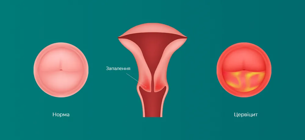 Цервіцит, запалення шийки матки