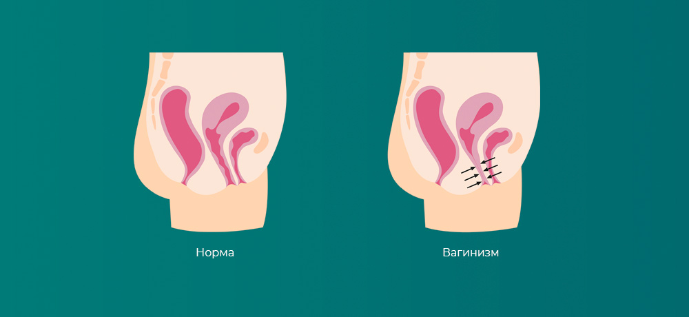 Вагинизм