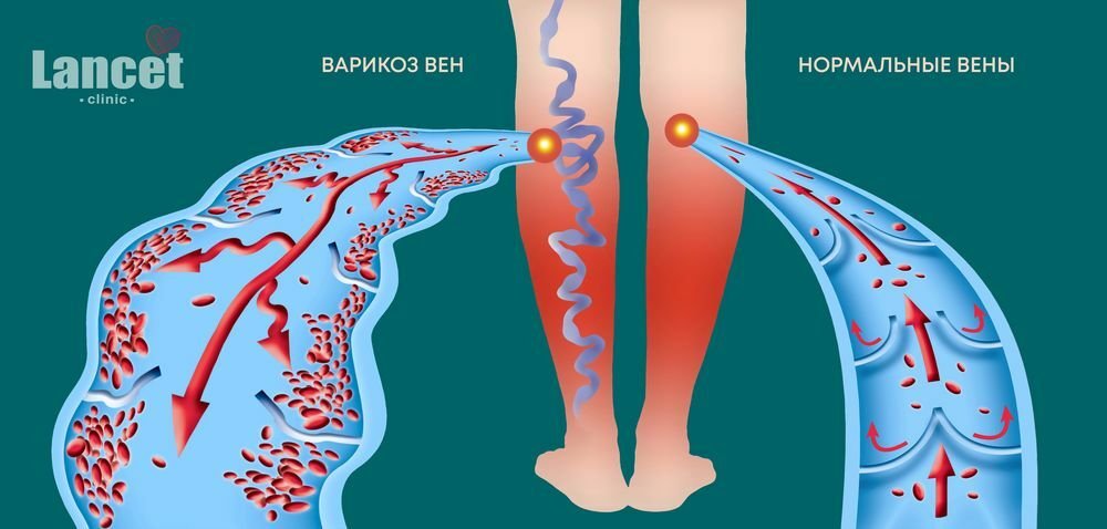варикоз вен, нормальные вены