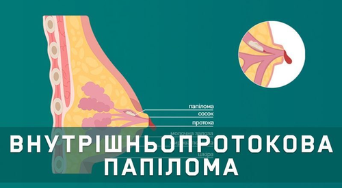 Внутрішньопротокова папілома молочної залози