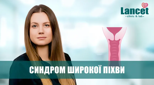 синдром широкої піхви, синдром вагінальної релаксації